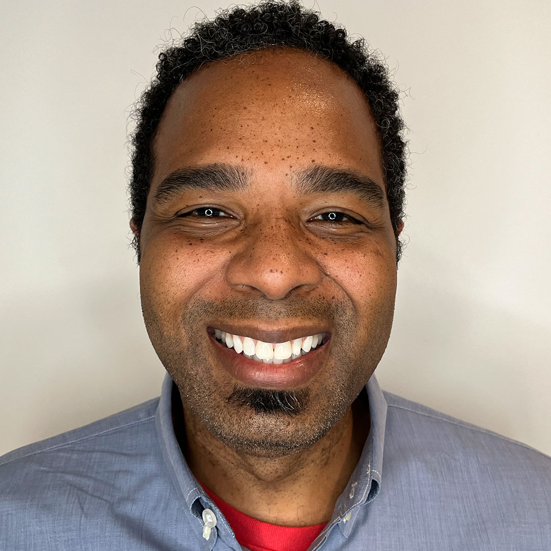 Botox-Charlie-Before