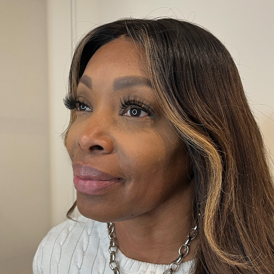 CollagenStimulation-Angie-After