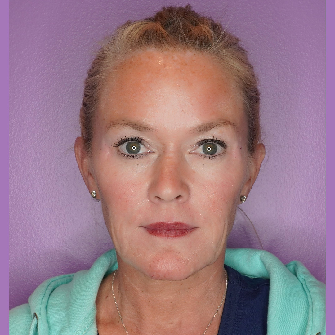 CollagenStimulation-Jane-After