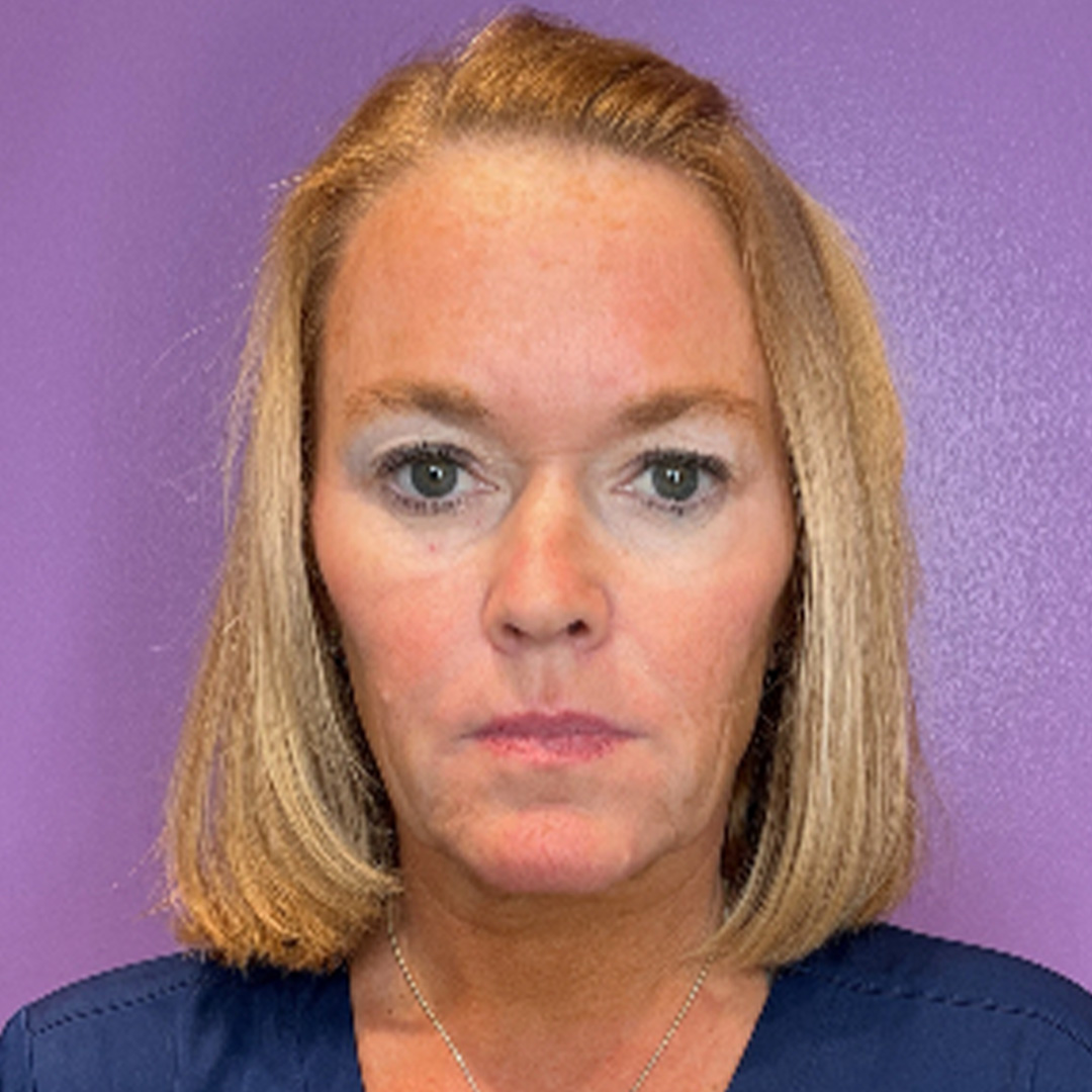 CollagenStimulation-Jane-Before