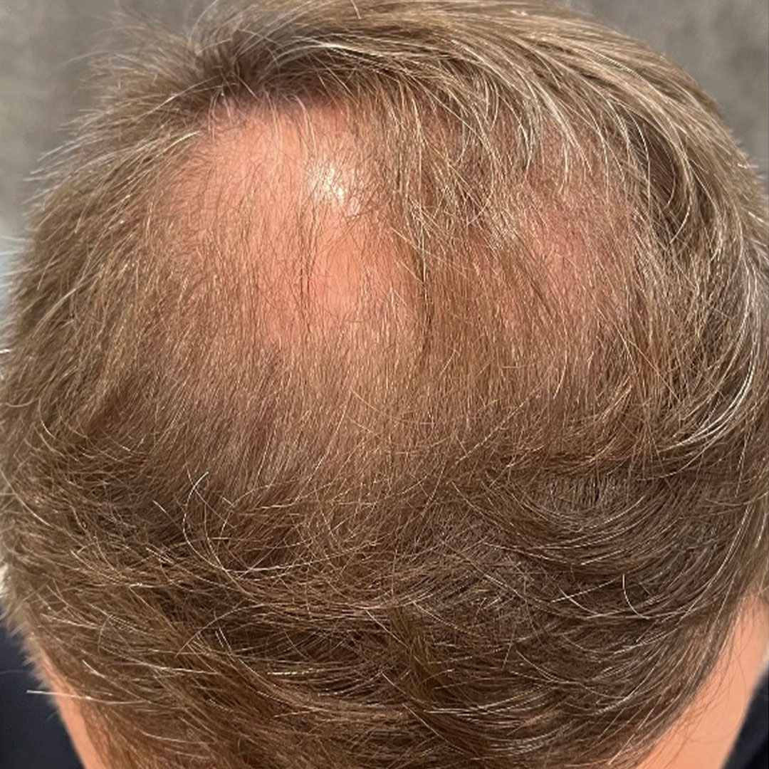 HairRestoration-After