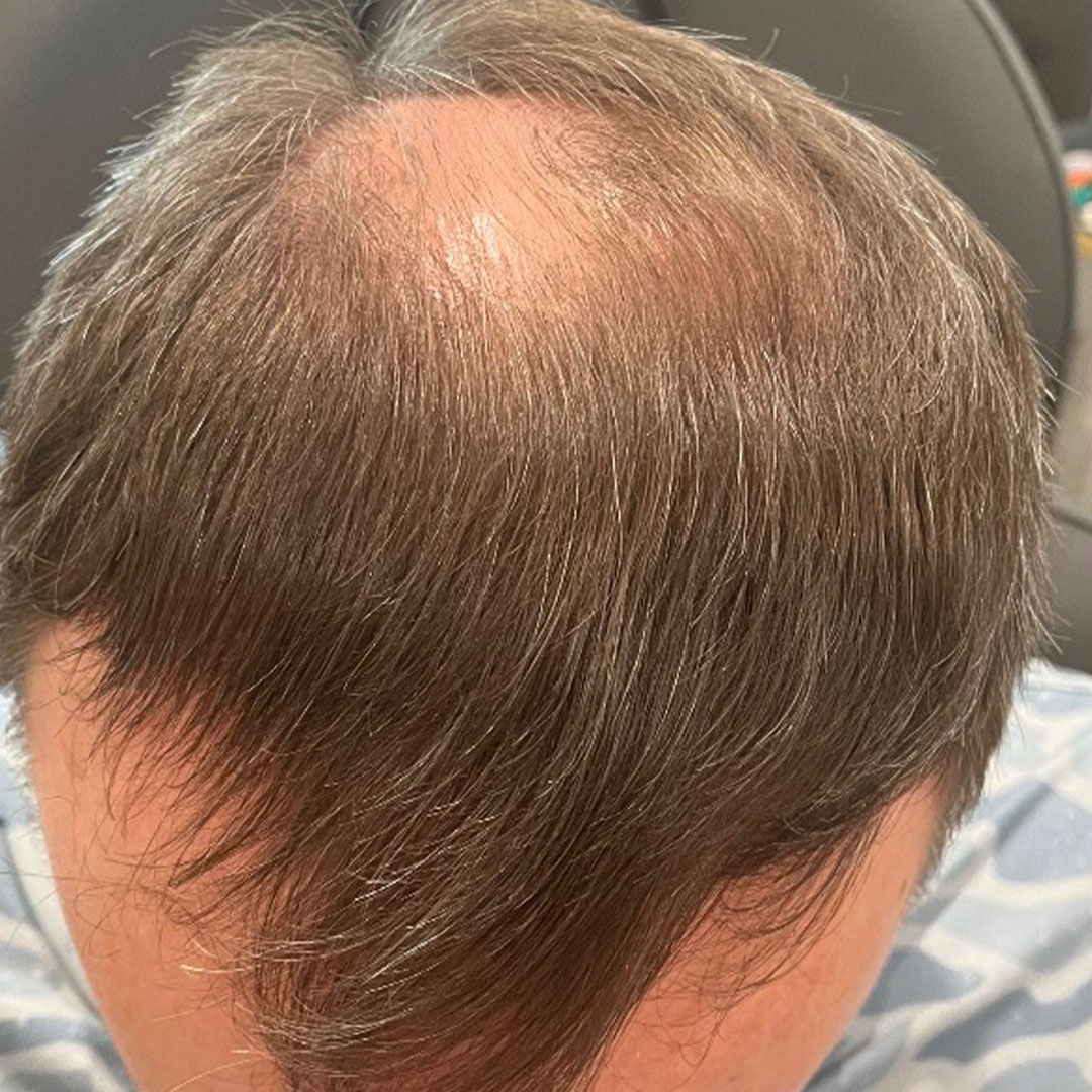 HairRestoration-Before