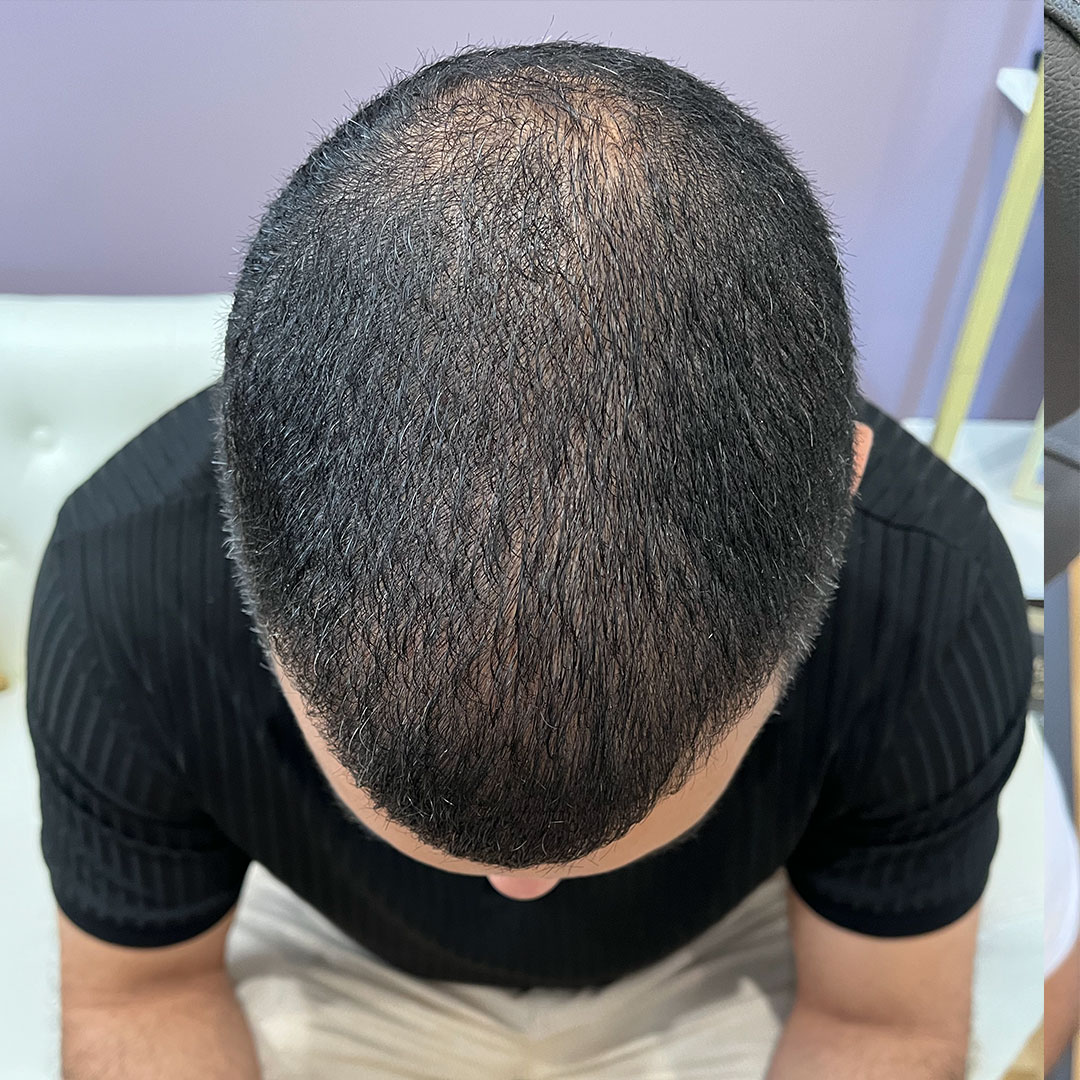 HairRestoration-Jackson-After