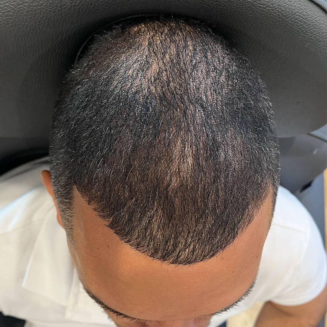HairRestoration-Jackson-Before