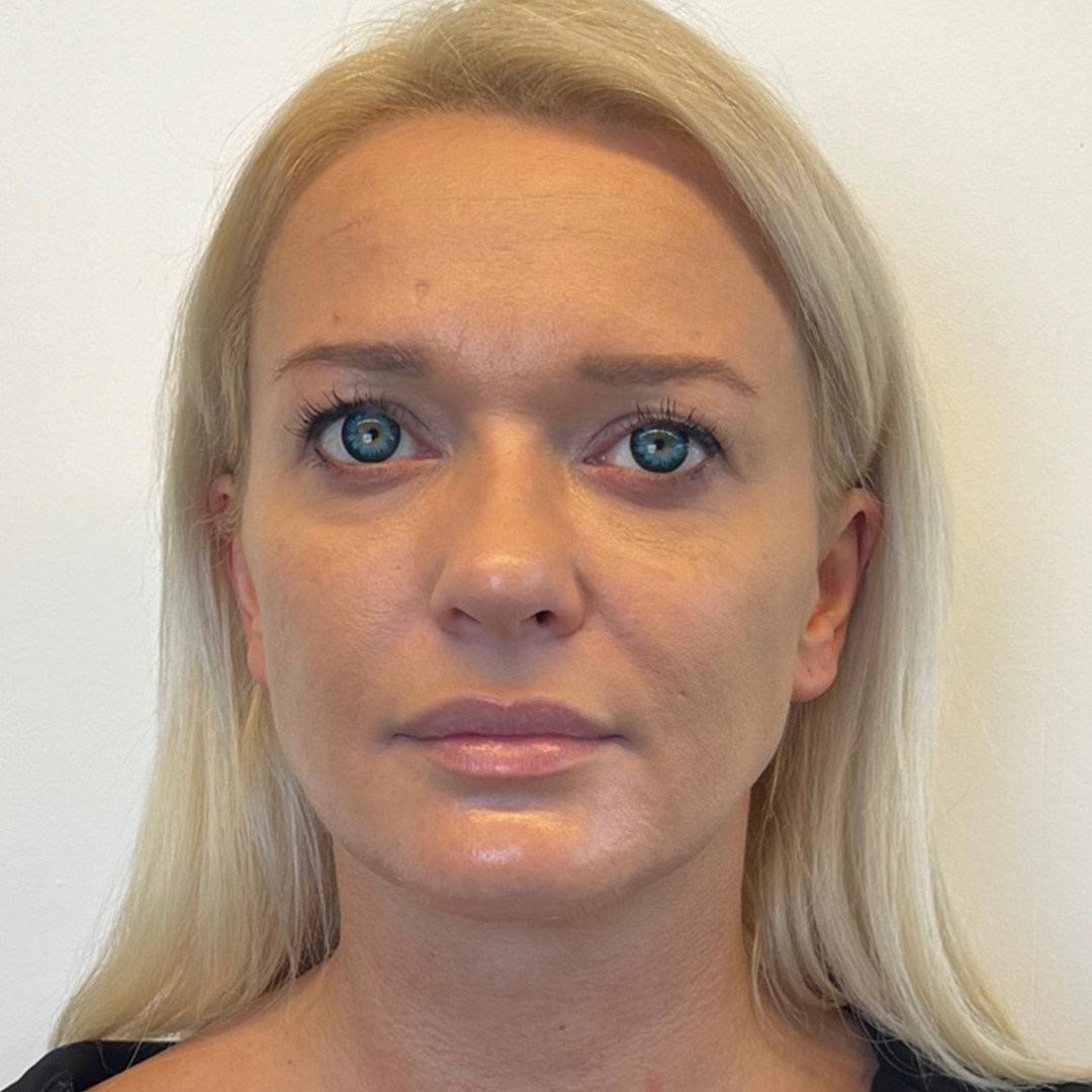 seamless-facialbalancing-after