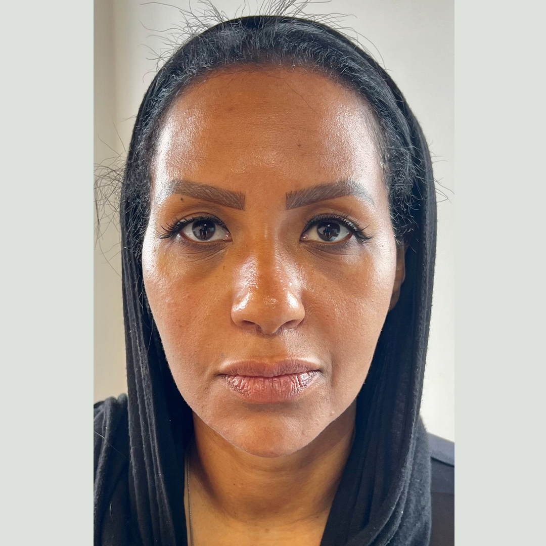 seamless-facialbalancing3-before