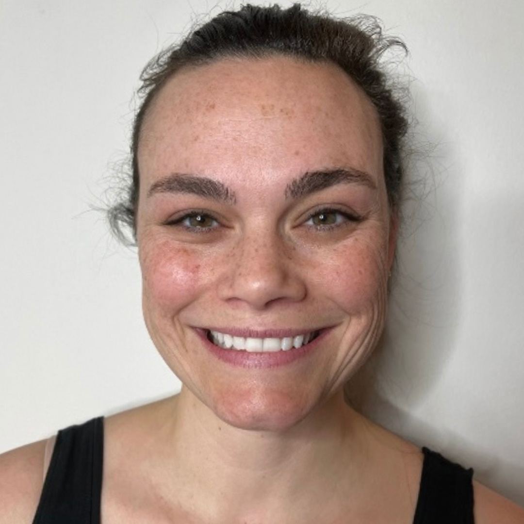 Skinvive-Brenda-Before