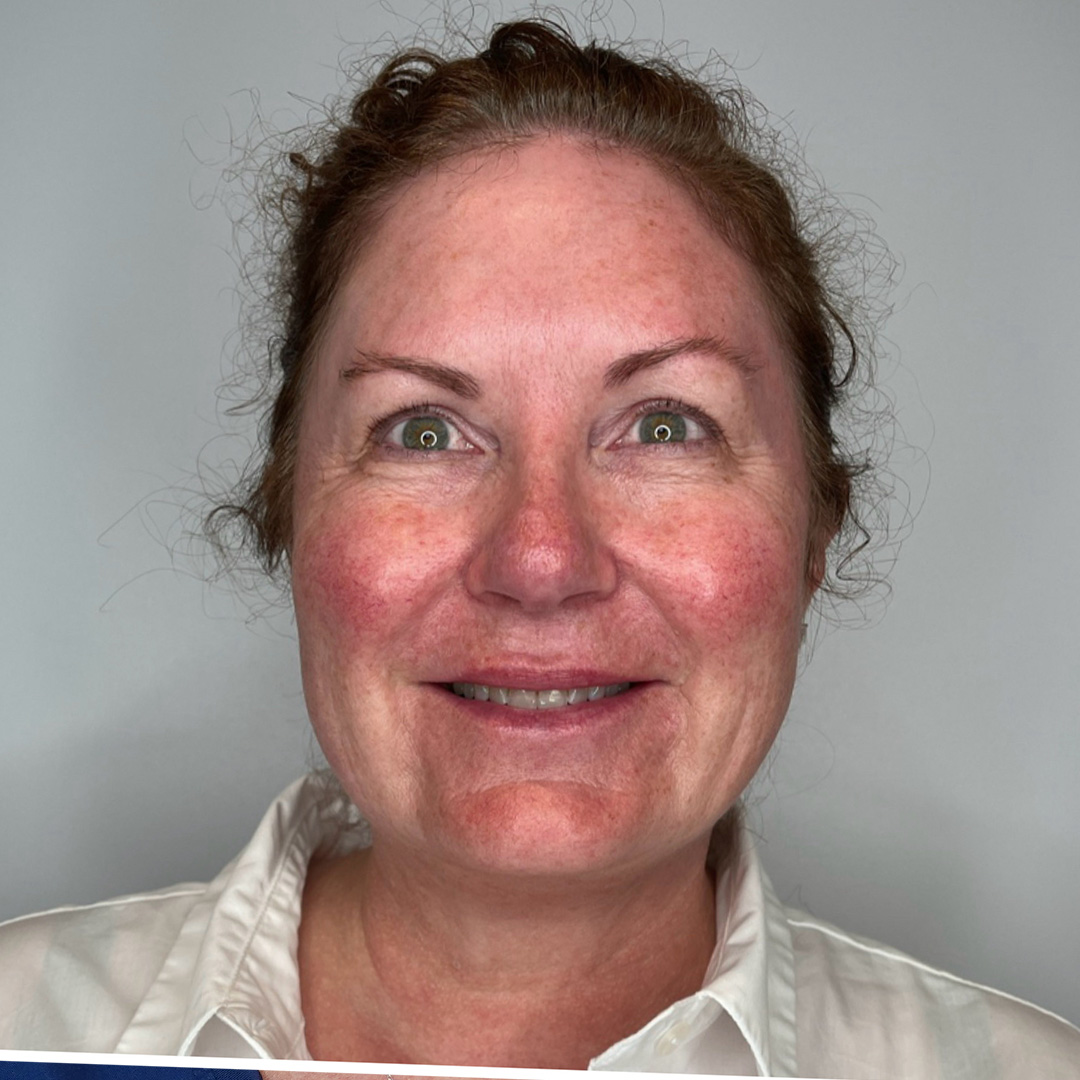 Skinvive-Janice-Before