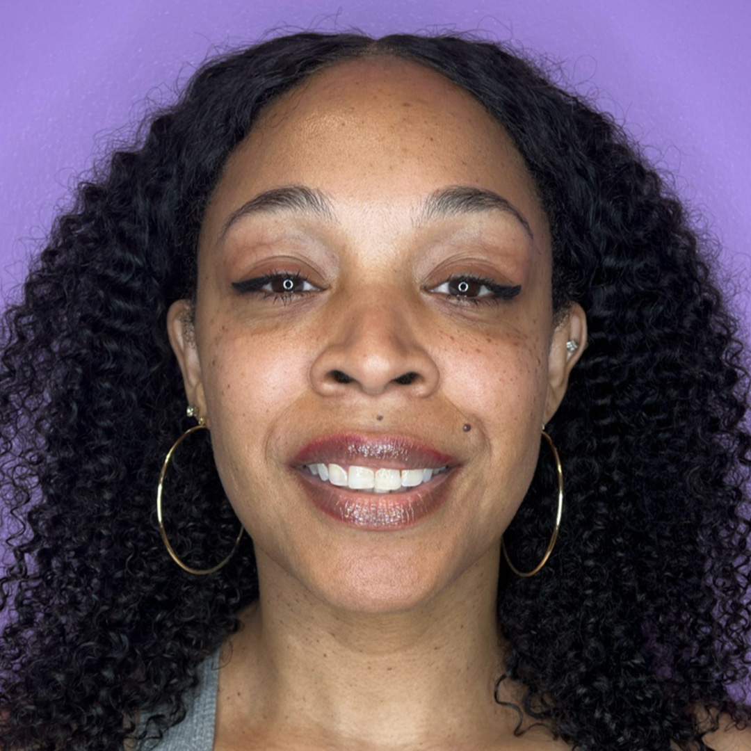 Skinvive-Mallori-Before2