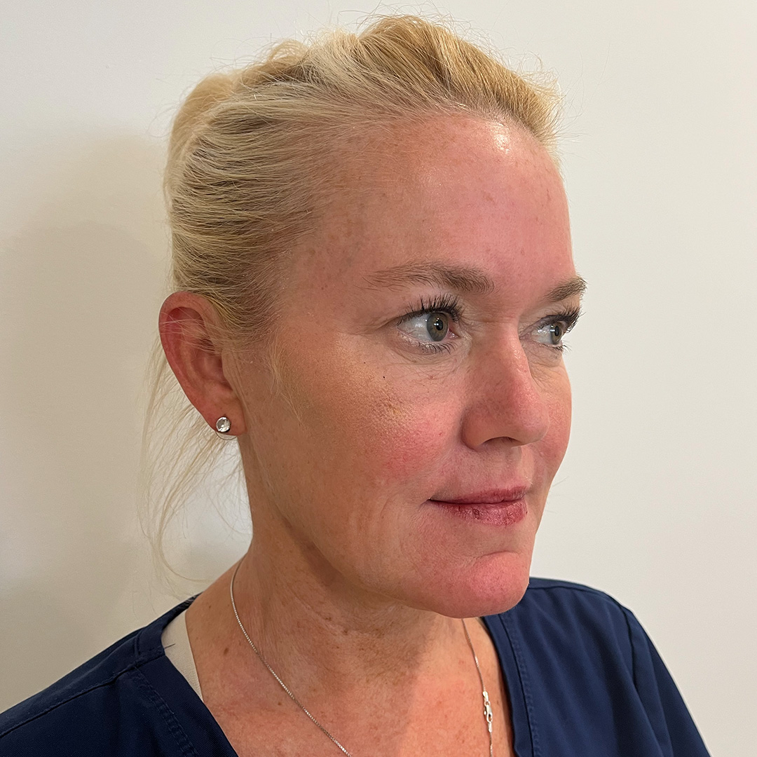 Skinvive-Susan-Before