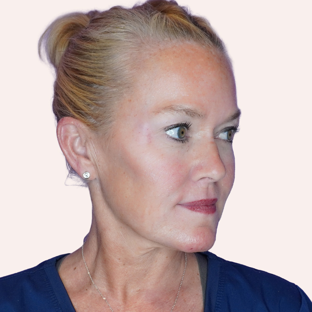 Botox-Susan-After
