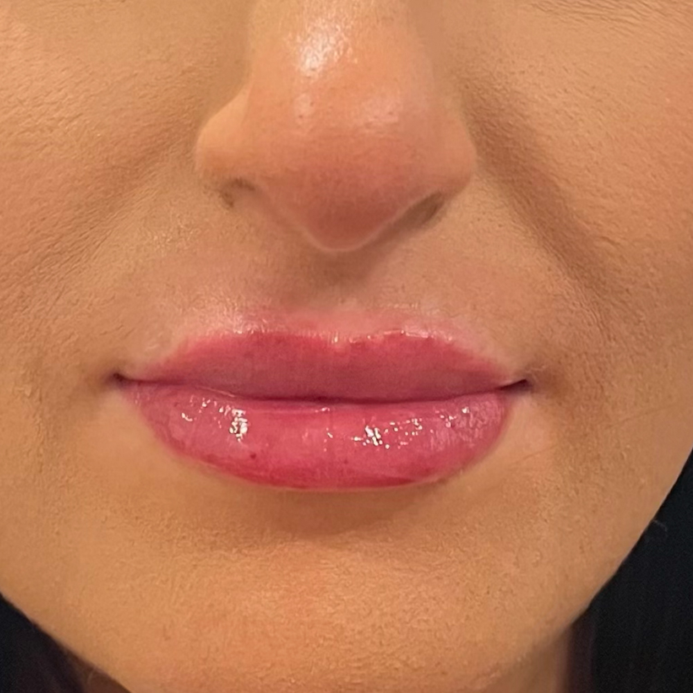 lips5-after